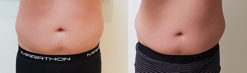 libocryo/fedtfrysning - Maven før og efter behandling
